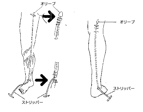 下肢静脈瘤説明図