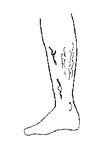 下肢静脈瘤説明図