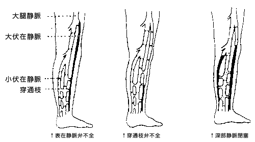 下肢静脈瘤説明図