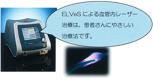 ELVeSによる血管内レーザー治療は、患者さんにやさしい治療法です。