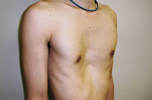 図1：22歳男性　漏斗胸手術前