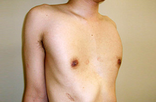 図2　22歳男性　漏斗胸ナス法手術後