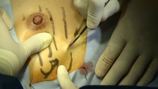 漏斗胸手術2 前回の手術瘢痕と同じところを切開