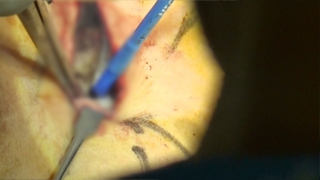 漏斗胸手術2 筋層下ナス法では、バーの端は傷口の外側まで入っている