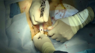 漏斗胸手術2 ドレーン(排液管)を挿入して留置