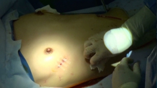 漏斗胸手術2 筋層、皮下組織、皮膚を縫合閉鎖