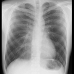 漏斗胸の身体異常　レントゲン正面像
