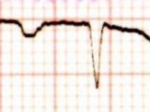 漏斗胸の身体異常　心電図