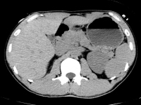 漏斗胸の身体異常　腹部CTの画像