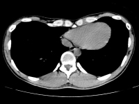 漏斗胸の身体異常　胸部CT