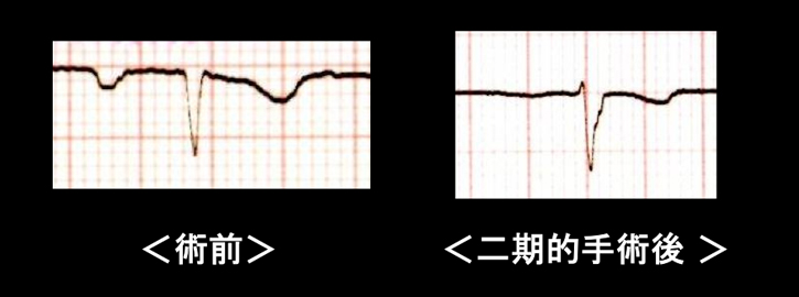 漏斗胸手術の効果 心電図1