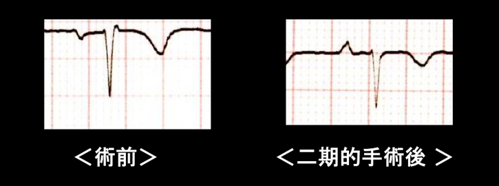 漏斗胸手術の効果 心電図2