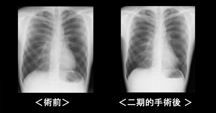 漏斗胸手術の効果 胸部Ｘ線撮影（正面像）