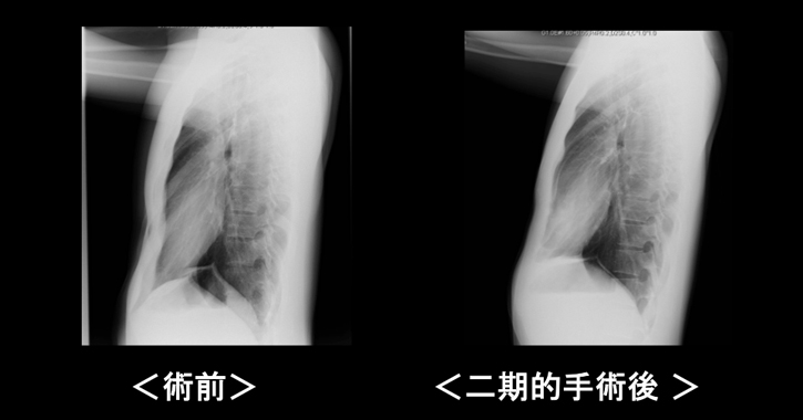 漏斗胸手術の効果  胸部Ｘ線撮影（側面像）