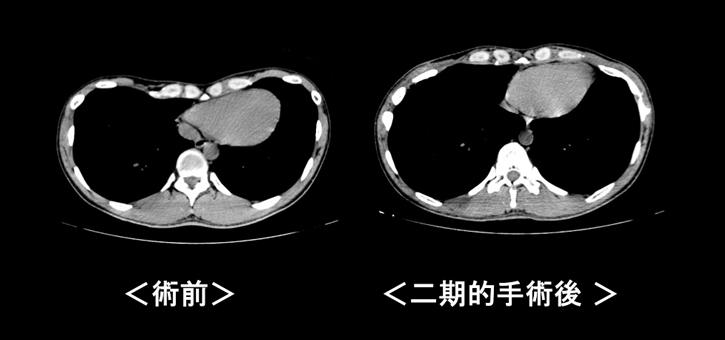漏斗胸手術の効果 胸部CT
