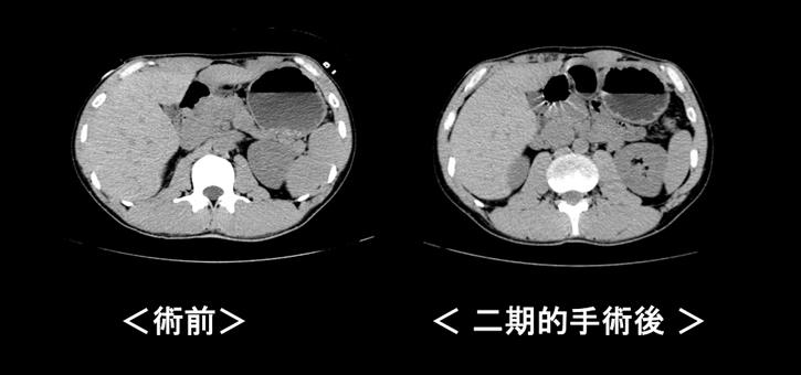 漏斗胸手術の効果 腹部CT