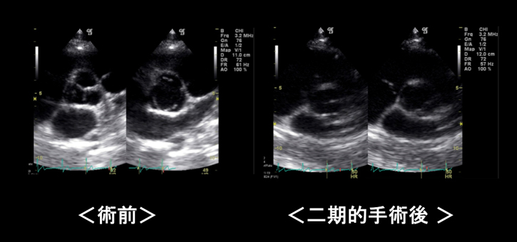漏斗胸手術の効果  心エコー