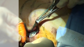 漏斗胸手術 バーを手術用ブレード縫合糸で肋骨2ヵ所に縛ります