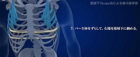 3.バー全体をずらして、右端を筋層下に納める