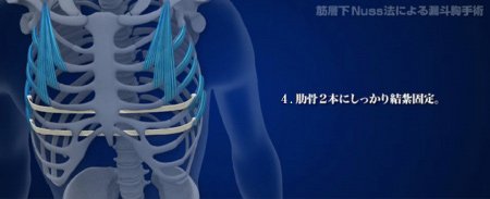 4.肋骨2本にしっかり結紮固定